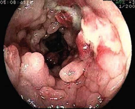 Infeksjoner 1. Bakterielle a. Clostridium difficile b.