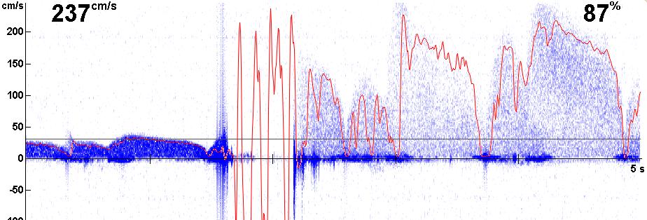 Søk (Search) Lokaliser (Detect) Verifiser (Verify) I en fortettet blodåre legges et såkalt bypass for å koble blodstrømmen rundt det fortettede området Dopplerproben søker og lokaliserer, flowproben