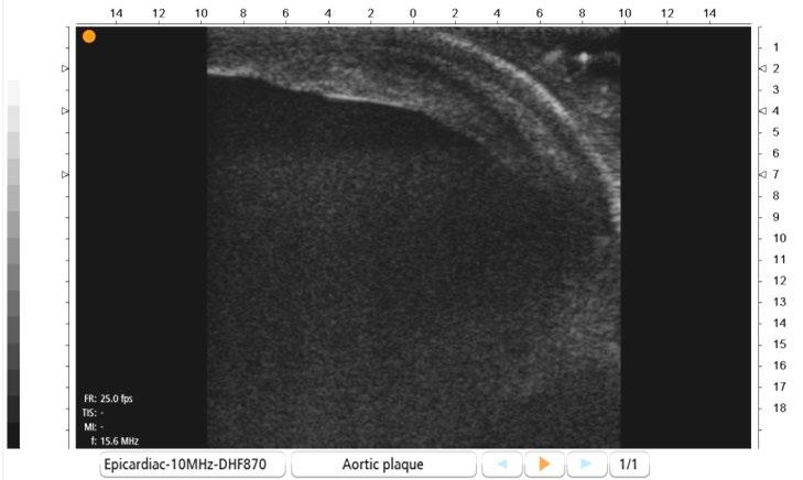 medfødte hjertefeil. Videre vil MiraQ Vascular utstyret ha anvendelse innen transplantasjonskirurgi og mange former for vaskulærkirurgi.