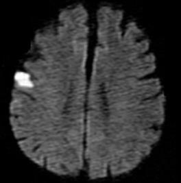Kortikalt hjerneslag Ve hemisfære: afasi, apraksi, agnosi Hjerne i lengdesnitt 1.