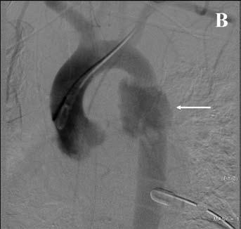 Traumatisk aortaskade Blant pasienter som overlever traumatisk aortaruptur, er skaden oftest beliggende i istmus distalt for avgangen av venstre arteria subclavia.