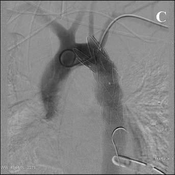 Det er ønskelig at man har en proksimal landingssone i frisk aorta på minst 10 mm. Stentgraftdiameter velges ca 10-20 % større enn aortadiameteren for å få graftet til å slutte tett mot karveggen.