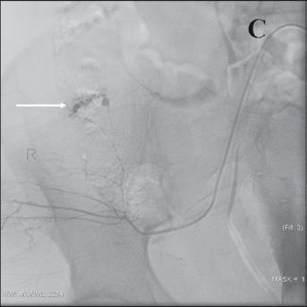 Should blunt arterial trauma to the extremities be treated with endovascular techniques? J Trauma 2005; 59: 1224-1227. 4. Dondelinger RF, Trotteur G, Ghaye B.
