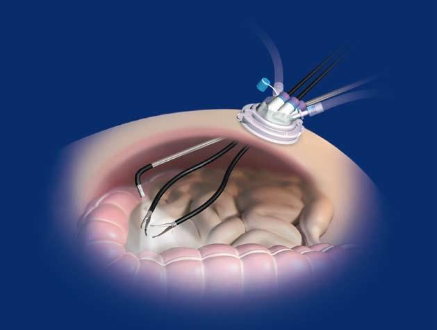 LESS - En port kirurgi LESS Laparo-Endoscopic Single-Site kirurgi, representerer starten på en av de mest banebrytene nyhetene innen medisinsk teknologi.