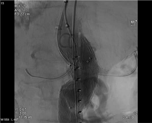 MINImalt INVASIV KIRURGI Ett års erfaring med bruk av endovaskulær Chimney teknikk i aneurismer i torakalog abdominal aorta Fig. 1.