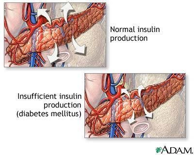 Diabetes mellitus - sukkersyke Ved sukkersyke er blodnivået av glukose forhøyet.