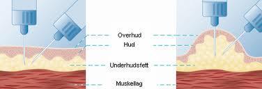 ANBEFALING LENGDE PÅ KANYLE UNGDOM OG VOKSNE 4 mm loddrett, uten løftet hudfold 5 mm loddrett, uten løftet hudfold BMI <18,5 vurdere hudfold