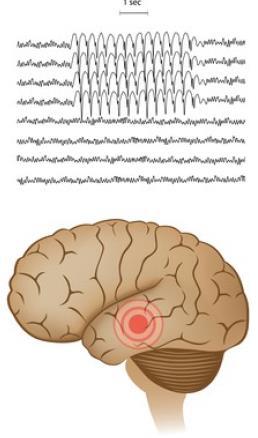 Fokale anfall Starter i et fokus av hjernen og gir symptomer tilvarende hva det området styrer.