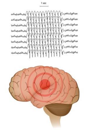 Generaliserte anfall Epileptisk aktivitet i begge hjernehalvdeler: Tonisk klonisk Atonisk (tap av
