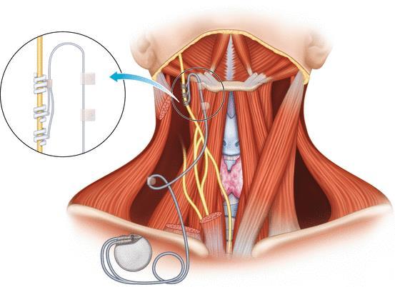 VNS: Vagus nerve stimulator