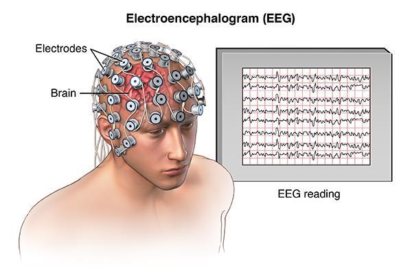 EEG: Elektroencefalografi Måling av elektrisk aktivitet i hjernen.