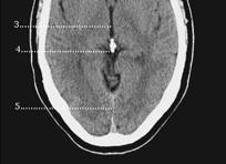 Neurosurgery for stroke 外科急性腦中風的相關外科處置 腦血管神經外科楊道杰醫師 1 大面積腦中風 malignant ischemic stroke 2 自發性蜘蛛膜腦下出血 :SAH 3 自發性腦出血 :spontaneous ICH 4 腦動靜脈畸形 : AVM 5 腦血管再暢流 : 頸動脈狹窄 : carotid neck stenos is, 顱內血管狹窄 :