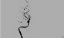 aneurysm 適應症 :1 顱內動脈瘤無法夾除者 2 顱底腦瘤 3