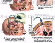 顱內壓監視器 顱內壓監視器形式 1 intraventricular cathter: 腦室內監視器 2 intraparencymal monitor: 腦實質內監視器 3 subarachnoid screws : 蜘蛛網下腔監視器 4 subdural : 硬腦膜下腔監視器 顱內壓的零點 : 外耳道 : 孟露孔