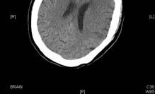 梗塞範圍擴大 出血性梗塞, 癲癇發作或其他內科併發症 腦水腫多在第二至第五天發生, 進而造成症狀惡化, 主要是意識障礙並常伴隨瞳孔變化與其他腦脫疝之徵象, 病人可能出現腦幹症狀與呼吸衰竭 大面積顱骨切除減壓手術 當病人惡化時, 適時的執行開顱減壓術能立即有效的降低顱內壓, 並改善腦組織血流, 可以降低死亡率至 30%