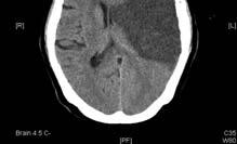 treatment failure 5 no severe medical disease 6 家屬可照顧嚴重 neurologic deficit 之 patient 10/14 10/17 大面積顱骨切除減壓手術 1 術後 GCS monitor : 有無 postop EDH,SDH OR