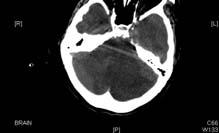 小腦半球之大範圍梗塞 Cerebellar infraction : 分 PICA (cerebellar tonsil /inferior vermis,sca( superior hemisphere or superior vermis ),others 早期發現 : 頭暈, 嘔吐,