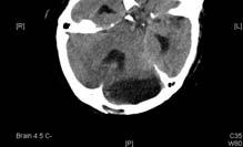 craniectomy 單以保守療法治療, 其死亡率亦高達 80%; 若適時的外科治療, 包括腦室引流及開顱解壓術可將死亡率降至 30% Indications : 1 第四腦室受壓迫有急性水腦 2 腦幹受壓迫 3 內科治療無效 Suboccipital craniectomy :