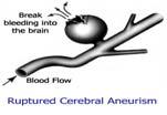 arachnoid membrane and the pia matter Categorization : 1 traumatic : most 2 nontraumatic :accouts for 1 to 7% of all strokes approximately 5% of