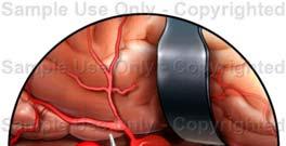 Endovascular therapy : 血管內治療 Guglielmi Detachable Coils 1 to promote thrombosis of the aneurysmal sac to prevent bleeding 2 to