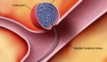 Location 50 % Striate body (basal ganglia); putamen most common; also includes: lenticular nucleus, internal capsule, globus