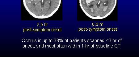 For supratentorial location <30 ml >30 ml Intraventricular blood No Yes 0 1 0 1 外科治療 對於自發性腦出血的患者是否需手術, 及何時手術, 均尚無定論 一般是以減輕腦壓為目標, 如血塊引起腦壓上升 水腦症 或血塊導致嚴重的腦水腫 一般手術方式分為以下幾種 腦室內腦壓監視器 : 可監測腦壓及引流腦脊髓液, 改善水腦症