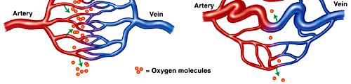 AVM ( 動靜脈畸形 ) 之外科療法 Arteriovenous malformation (AVM) Congenital 先天性 98% solitary 病理機轉 Dilated arteries and vein without capillary bed May contain gliotic brain, hemorrhagic residua Flow related