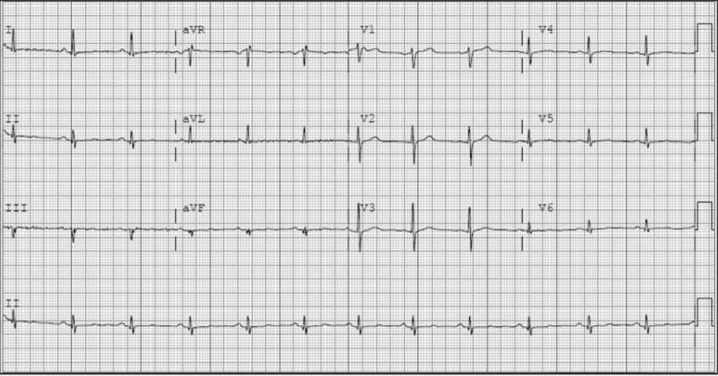 EKG i akuttmottak