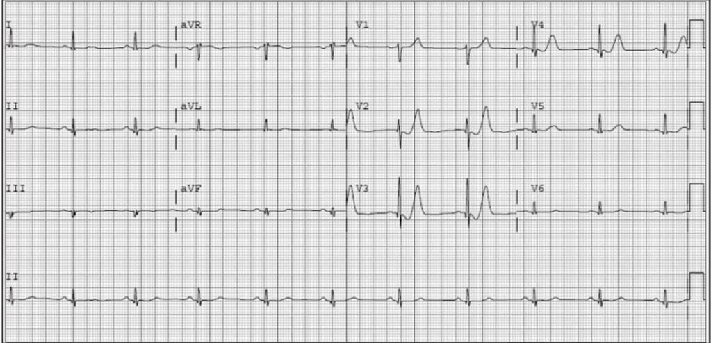 EKG 90 min senere akkurat