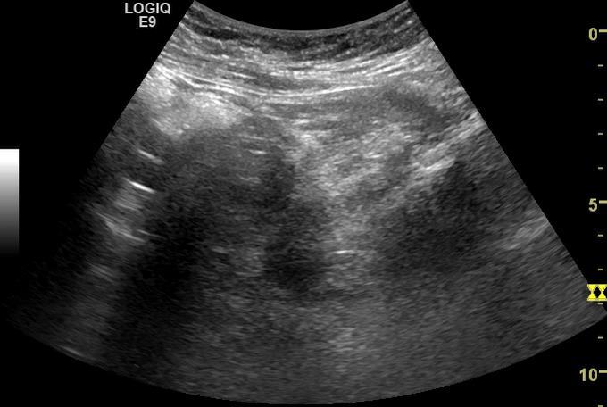 transversalt og longitudinalt Størrelse Lengde 4-8 cm Bredde 2-5 cm Hyperekkogen, men endometriet lysere Ovarier Størrelse
