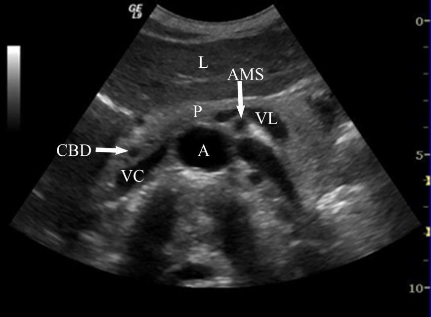 Stasjon 1-6 -Stasjon 1 Transversalsnitt i epigastriet Bruk kjente anatomiske landemerker til orientering: Aorta, vena cava, art. mesenterica superior, pankreas og lever.