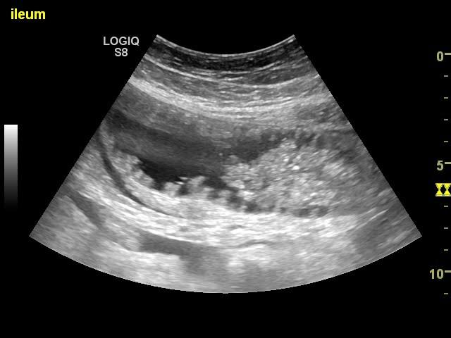 Kasuistikk 10 Dilatert ileum uten