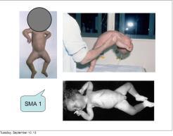 SMA - spinal muskel atrofi Forekomst 1: 11 000 Autosomal recessiv.