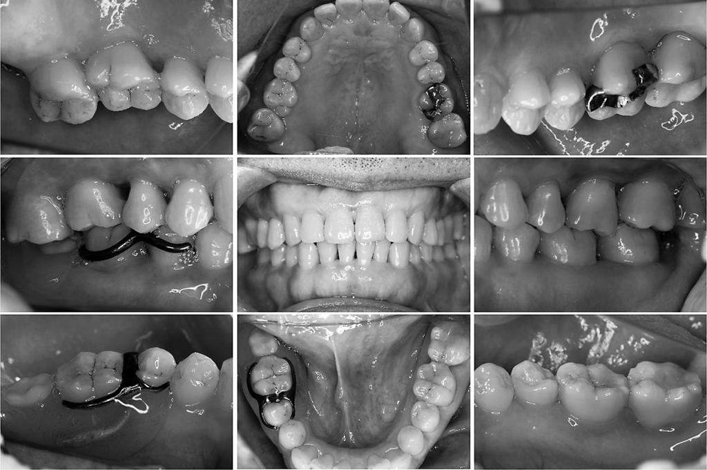 102 Seshima F et al. Fig. 5 Oral view after 7 months of supportive periodontal therapy (SPT) Fig. 6 Periodontal examination after 7 months of SPT DM.