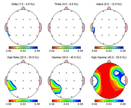 Vi ser også en signifikant økning av Theta venstre frontalt (F7 - FP1) og høysignifikant høyre occipitalt