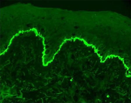 Autoimmune Disease: Antibodies Bind to Skin Proteins