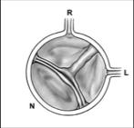 Bikuspid aorta Incidens 1-2% Þ > død og morbiditet enn alle andre congenitte hjertefeil til sammen ü BAV à 50-70% behandlingstrengende aortaklaffsykdom ü Fylte 55 år kun: ü 10%