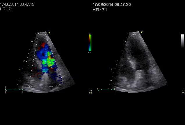 Isolert basal septumhypertrofi ( septumvalk ) Lett hypertrofi kombinert med økt vinkel mellom aorta og VV kaviteten Ofte i kombinasjon med HT Sjelden