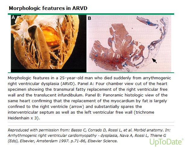 Arytmogen høyre ventrikkel kardiomyopati Prevalens 1/2000-5000 ARVC impaired cell adhesion hypothesis løsning av