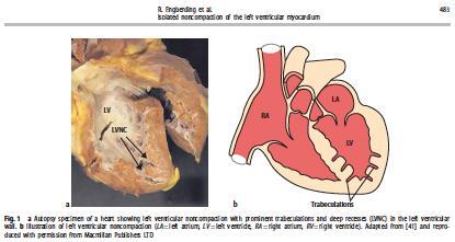 Isolated noncompaction of the left ventricular myocardium (INVM) Medfødt CM(?
