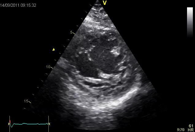 Ekkokardiografi (Jenni 2005) INVM: Diagnostikk MR 4 trabekler med dype intertrabekulære recesser Flow inn i recessene (fargedoppler) Affiserer apex