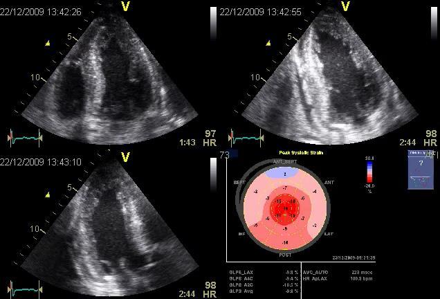 16, 280 EKG: Low voltage vs