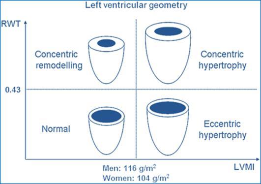 Bergen Hypertension and Cardiac Dynamics Group/Department of Clinical Science Ganau A et el. J Am Coll Cardiol 1992;19:1550-1558 Devereux RB et al.