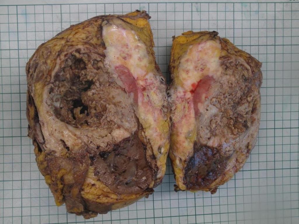 Makroskopisk undersøkelse Stor nyre med diameter 17.5 x 12.7 x 9 cm Tumor i øvre og midtre del av nyren med diameter 11.2 x 12.