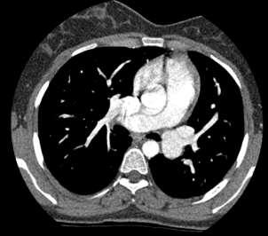 å påvise uforklart shunt Har ofte to høyre lungevener CT!