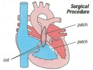 Fallots Tetrade Ukorrigert VSD Overridende aorta Pulmonal stenose RV hypertrofi Etter korreksjon