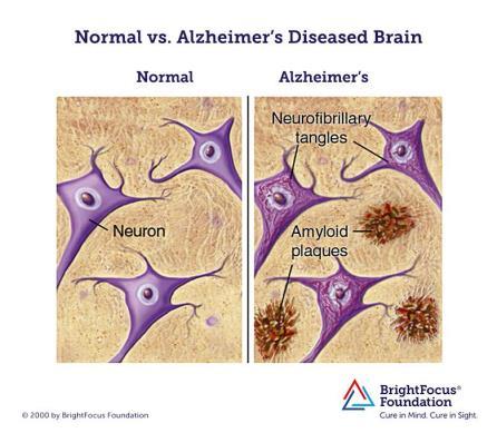 Felles for demenstilstandene Ødelagte proteiner hoper seg opp i hjernen og skader hjerneceller Beta amyloid Områder med nedsatt blodforsyning Nerveceller og