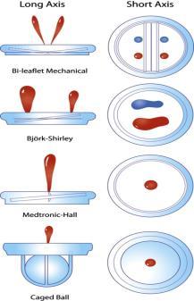 Transvalvulær trykkgradient/ effektivt åpningsareal: Modifisert Bernuoulli: Trykk gradient = 4 x (V maks) 2