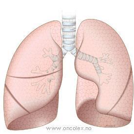 Lungekreft Av totalt 3035 nye lungekrefttilfeller i Norge i 2015, 1564 hos menn 1471 hos kvinner.