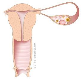 Gynekologisk kreft I 2015 fikk 1786 kvinner